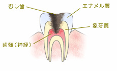 歯髄（神経）まで進行した虫歯
