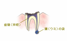 歯全体に進行した虫歯